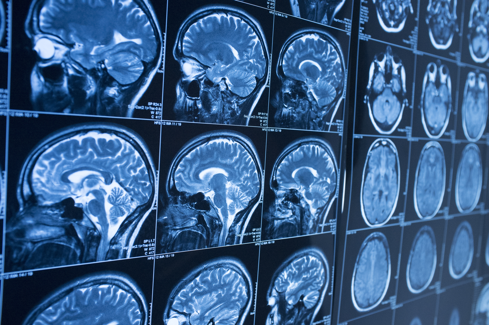 What Is a Coup-Contrecoup Brain Injury?