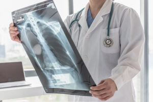 Zavodnick & Lasky Personal Injury Lawyers | Herniated Discs What Is a Herniated Disc?