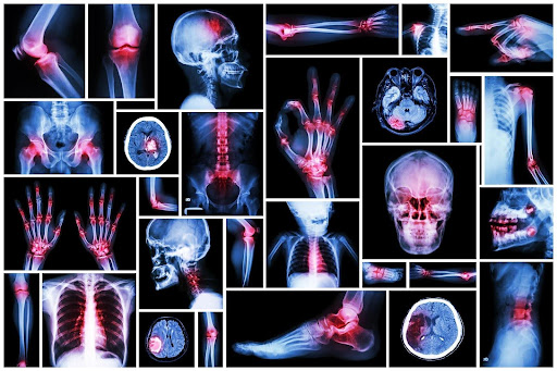 Examples of a catastrophic injury. Examples of a catastrophic injury.