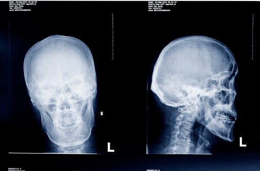 While X-rays like these do not necessarily show brain injuries, they can show skull fractures from penetrating injuries. Big insurance companies may require extensive evidence to prove these kinds of claims. While X-rays like these do not necessarily show brain injuries, they can show skull fractures from penetrating injuries. Big insurance companies may require extensive evidence to prove these kinds of claims.