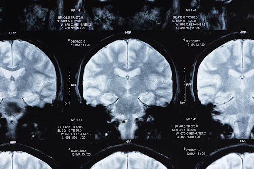 A magnetic resonance image stemming from a traumatic brain injury lawsuit. A magnetic resonance image stemming from a traumatic brain injury lawsuit.